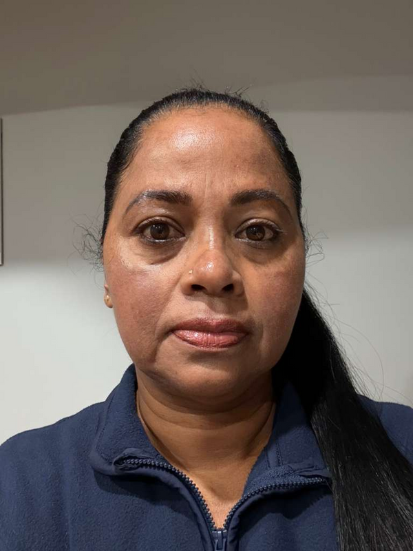 Dark Patches on Cheeks