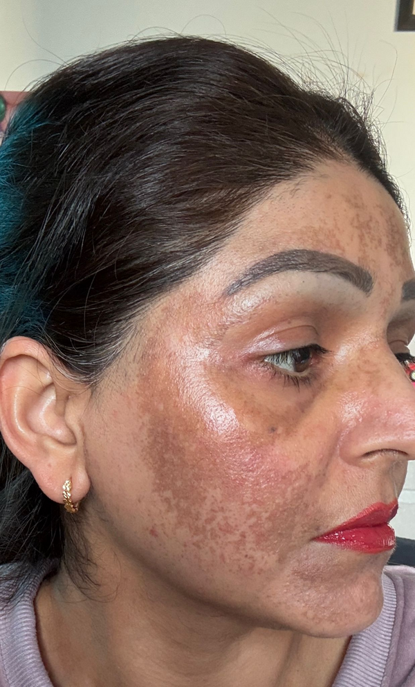 Uneven Skin Tone
