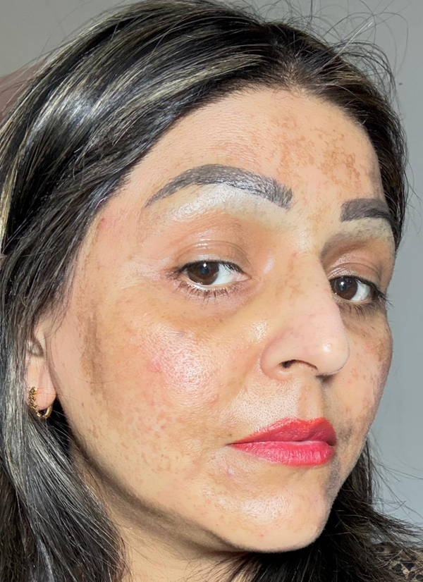 Uneven Skin Tone