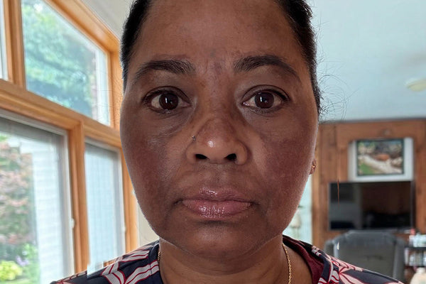 Dark Patches on Cheeks